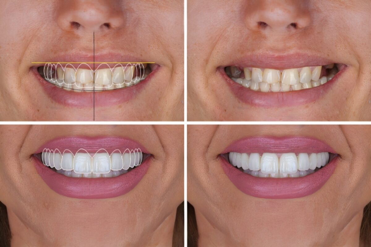 Cosmetic and aesthetic dentistry smile enhancement