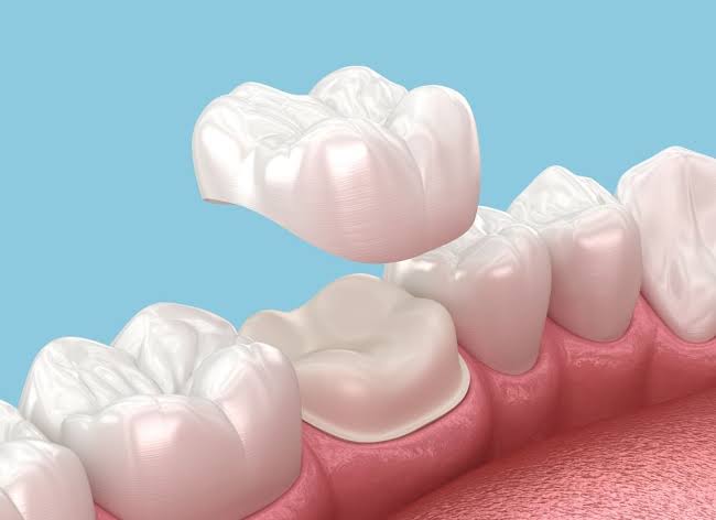 Crown and bridge fixed prosthodontics