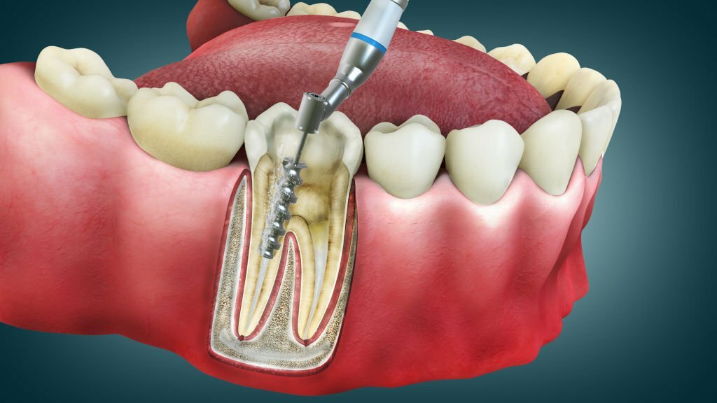 Endodontics and root canal treatment
