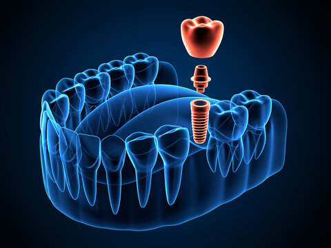 Dental implants and implantology