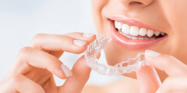 Braces and clear aligners for orthodontics