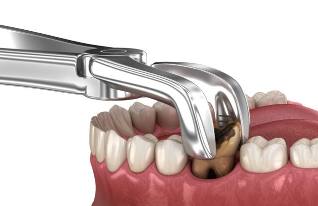 Oral and maxillofacial surgery, tooth extraction